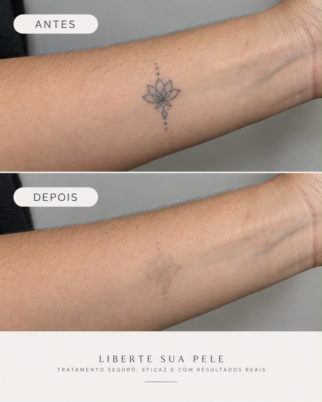 Antes e depois real de remoção de tatuagem no pulso