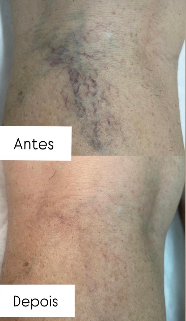 Resultado real de escleroterapia estética em perna