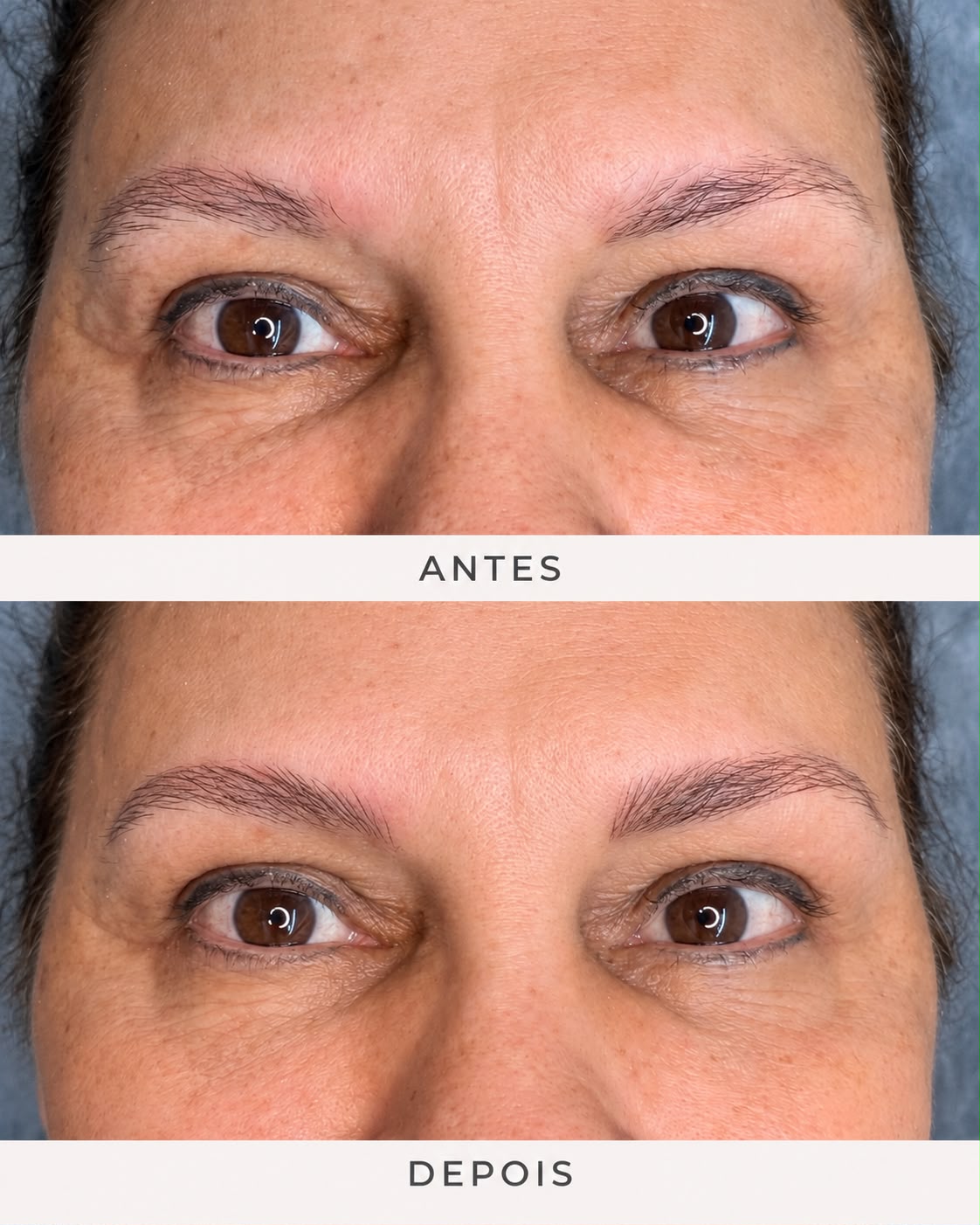 Antes e depois real de nanofios para sobrancelhas