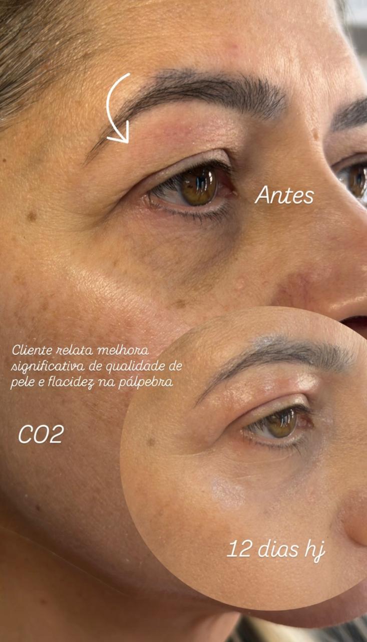 Resultado real de tratamento com Laser CO₂ na região dos olhos