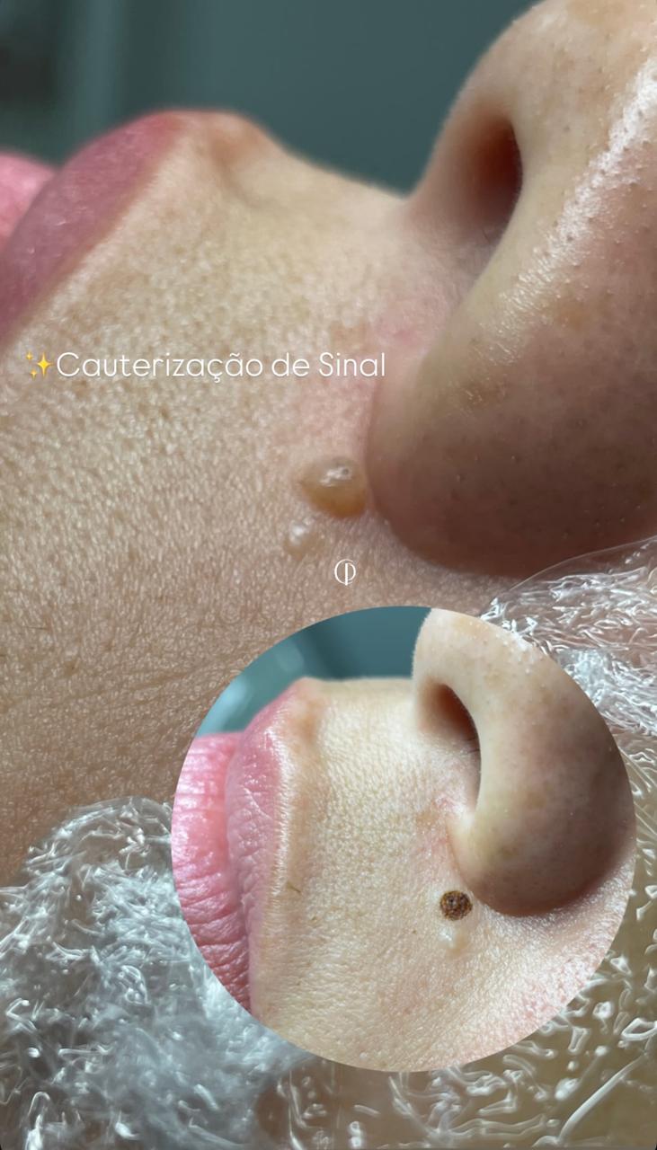 Resultado real de cauterização estética de sinal no rosto