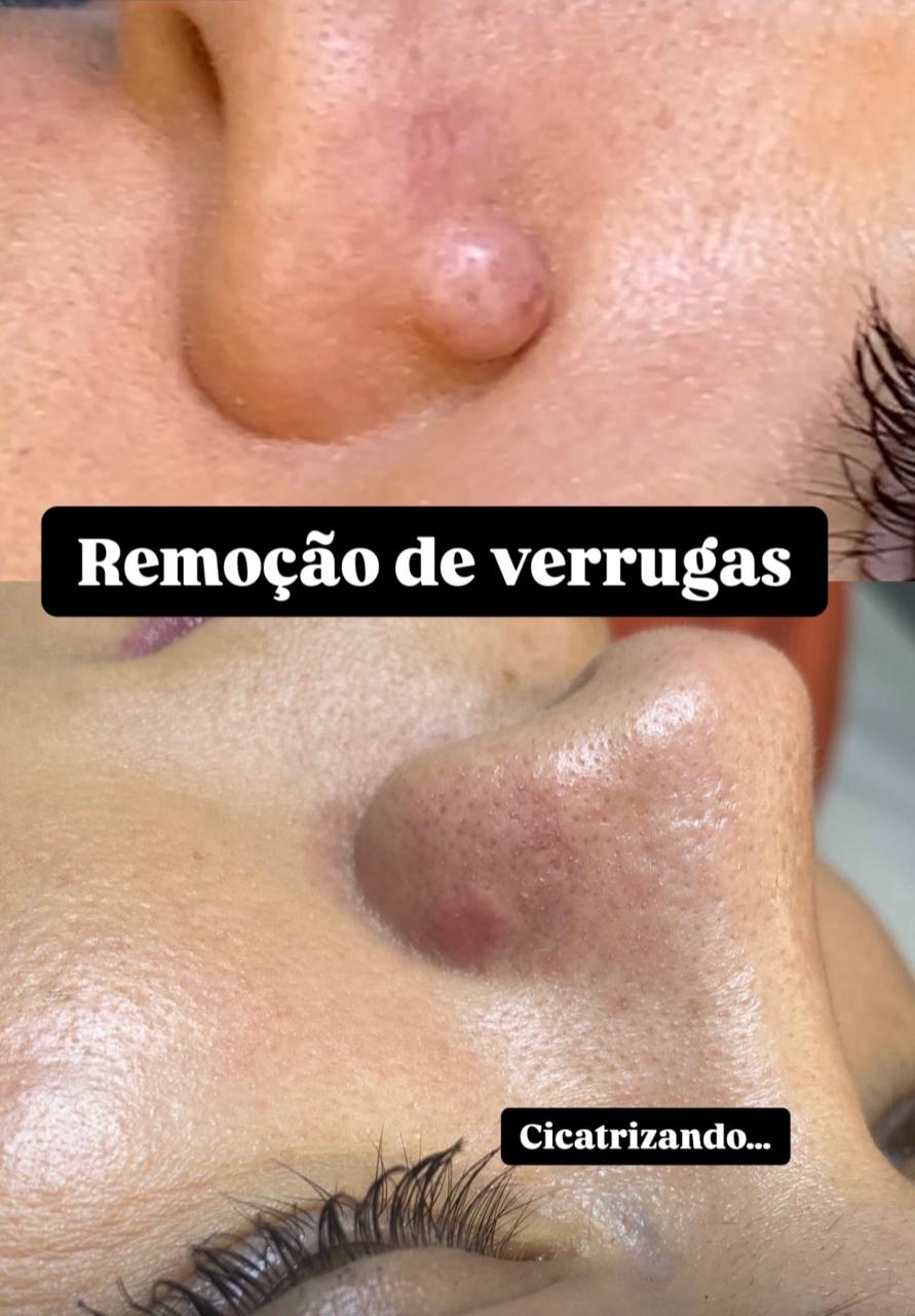 Remoção de verruga